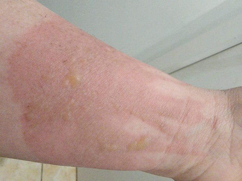 Hygia Helps with Customers Burns