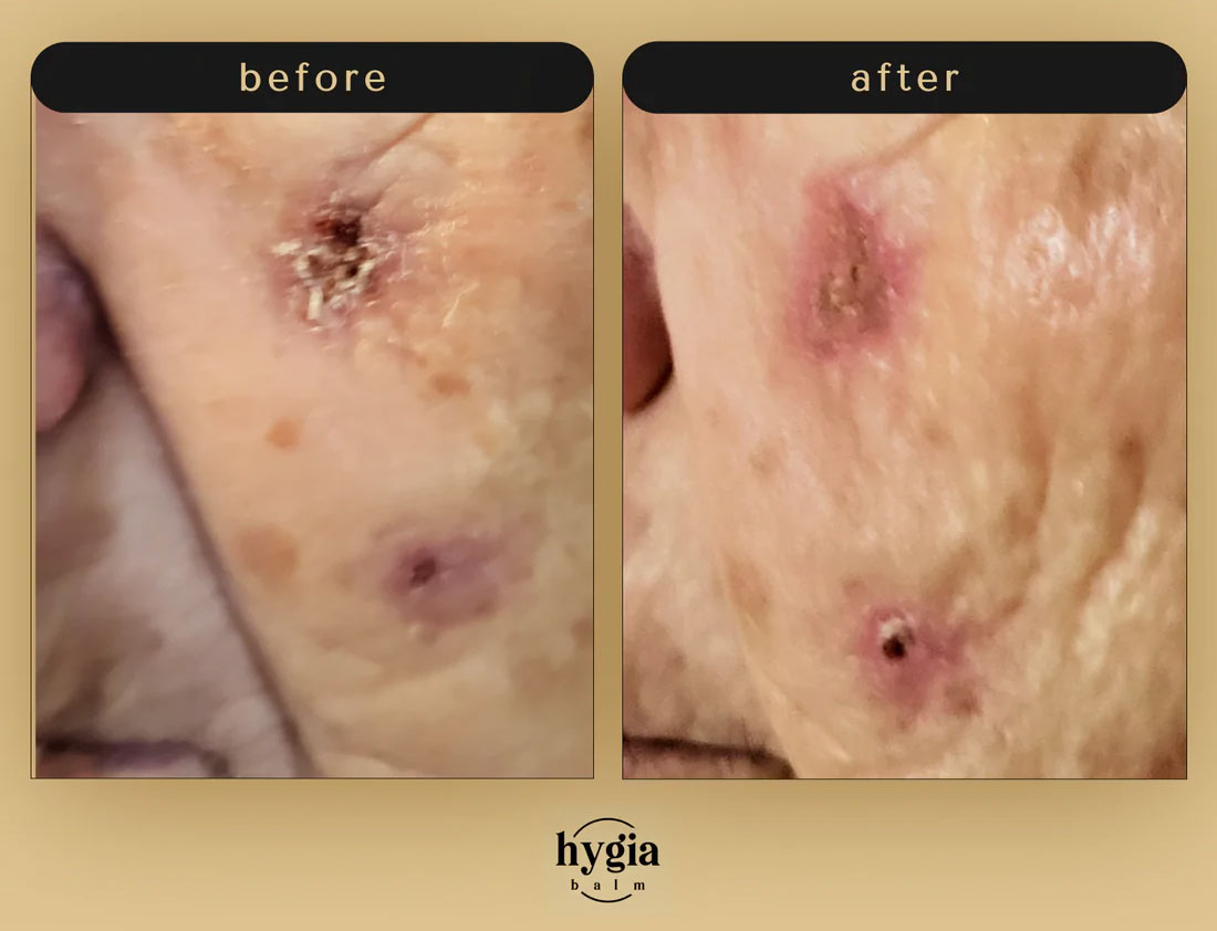 Deep wounds on face fixed with Hygia Balm