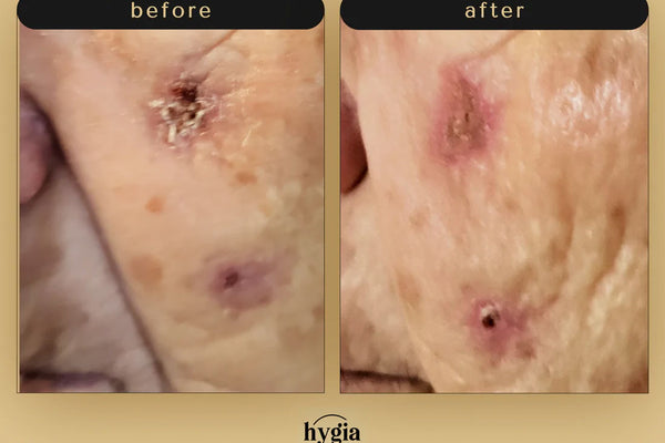 Deep wounds on face fixed with Hygia Balm