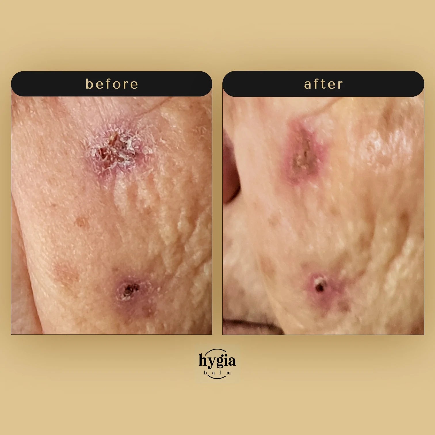 Hygia Balm 28g Jar
